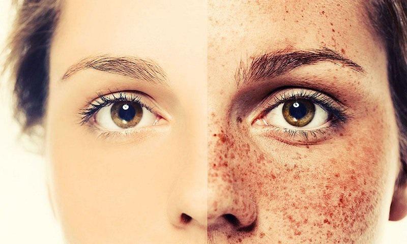 درمان لک های پوستی با روش های خانگی