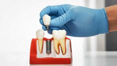 بررسی جدیدترین قیمت ایمپلنت دندان