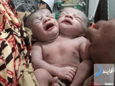 نوزادی با دو سر در بنگلادش به دنیا آمد