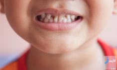 چطور از پوسیدگی دندان‌ کودکان جلوگیری کنید