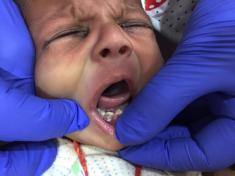 نوزادی در هند، با هفت دندان بدنیا آمد!