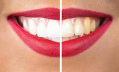 دلایل تغییر رنگ و زرد شدن دندان‌ها + روش هایی آسان برای سفید کردن دندان‌