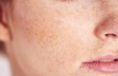 مشکلات پوستی / تشخیص بیماری های خطرناک از روی پوست
